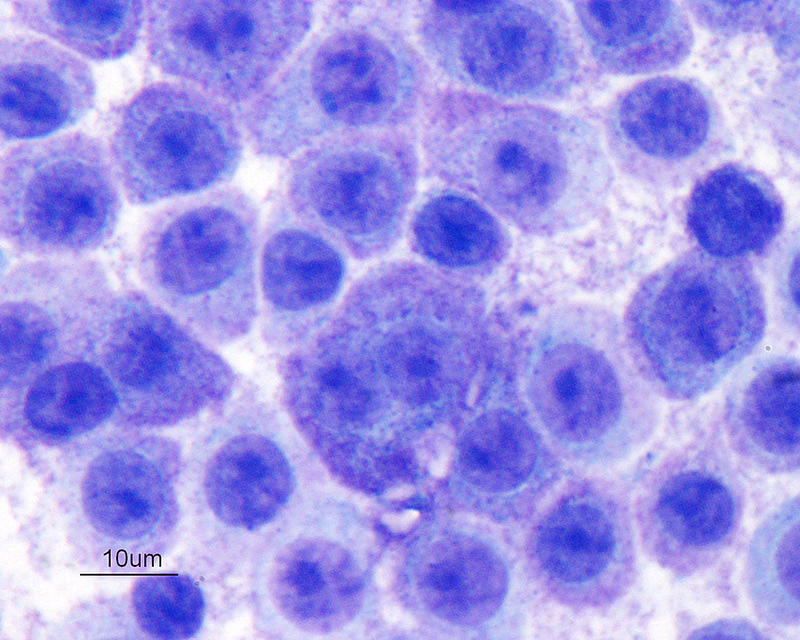 "Discrete" cell tumors eClinpath