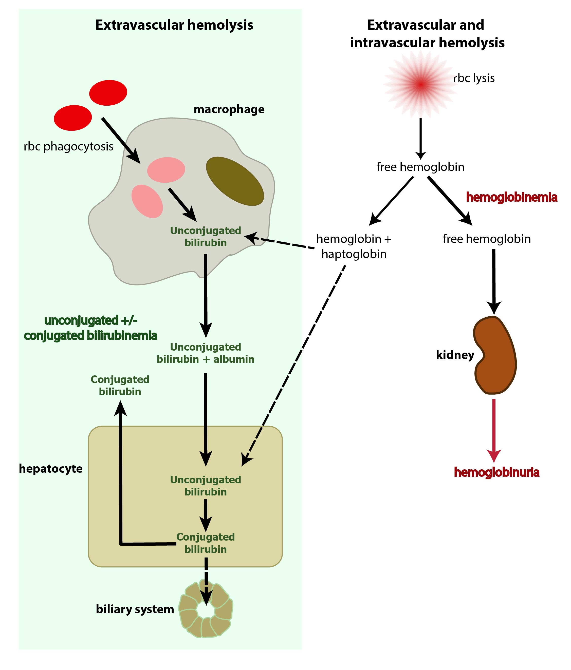 Bilirubin And Hemolytic Anemia EClinpath