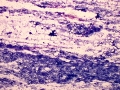 Smudged cells