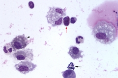 Bronchoalveolar lavage