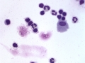 Asthma & pneumonia