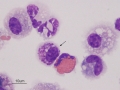 Eosinophilic & mastocytic IAD