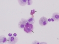Eosinophilic & mastocytic asthma