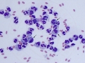 Bile peritonitis