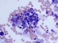 Lymphoma of granular lymphocytes
