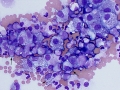 Lymphoma of granular lymphocytes