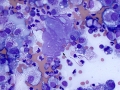Lymphoma of granular lymphocytes