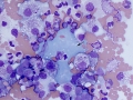 Lymphoma of granular lymphocytes