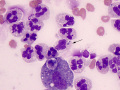 Neutrophil with lipofuscin