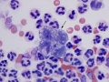 Bacterial infection