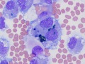 Bile casts in macrophage