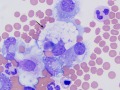 Necrotic debris in macrophage