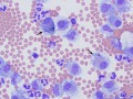 Bile casts in macrophages