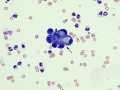 Neoplastic effusion