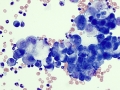 Neoplastic effusion
