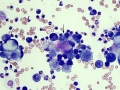Neoplastic effusion