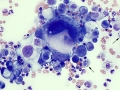 Neoplastic effusion
