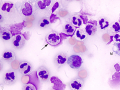 Septic peritonitis