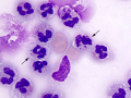 Septic peritonitis