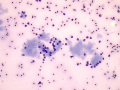 Bile peritonitis ("white bile")