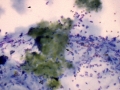Bile peritonitis