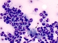 Bile peritonitis