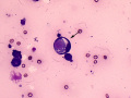 Cannibalism (carcinoma)