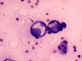 Cannibalism (carcinoma)
