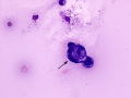 Cannibalism (carcinoma)
