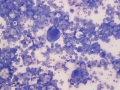 Carcinoma
