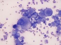 Carcinoma