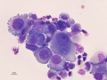 Carcinoma