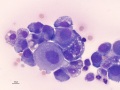 Carcinoma