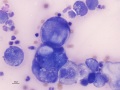 Carcinoma