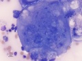 Carcinoma