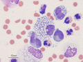 Chylous ascites