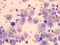 Chylous ascites
