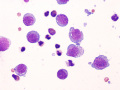 Lymphoma