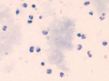 Bile peritonitis ("white bile")