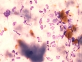 Bile peritonitis