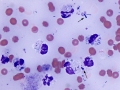 Septic peritonitis