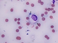 Septic peritonitis