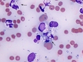 Septic peritonitis