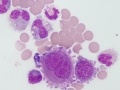Metastatic carcinoma (CSF)
