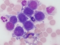 Metastatic carcinoma (CSF)