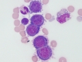Metastatic carcinoma (CSF)