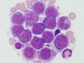 Metastatic carcinoma (CSF)