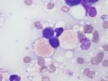 Metastatic carcinoma (brain mass)