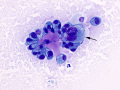 Metastatic carcinoma
