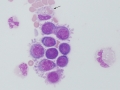 Metastatic carcinoma (CSF)